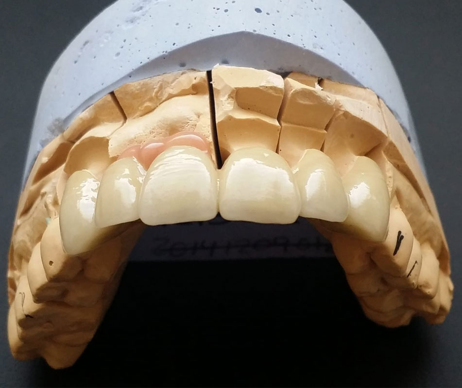 Metal Cerámica